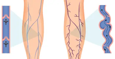 presoterapia y varices