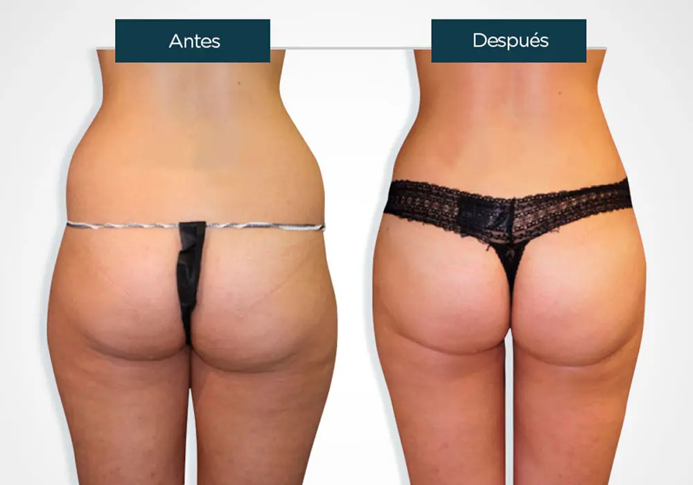 Lipolaser y Presoterapia antes y despues