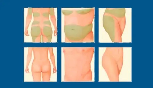 Lipolaser y Presoterapia color