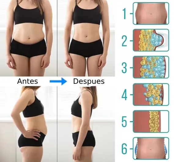 Presoterapia vs Criolipólisis 04