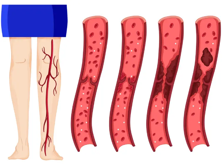 arañas_vasculares_y_presoterapia_03